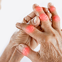 Rheumatoid Arthritis