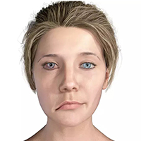 bells palsy